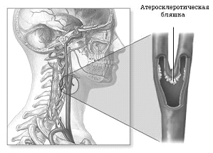 Диагностика стенозов сонных артерий в Центре Современной Кардиологии Красноярск