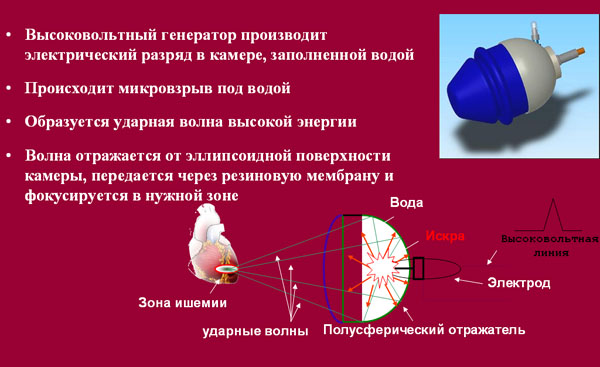 Кардиологическая ударно-волновая терапия в Центре Современной Кардиологии